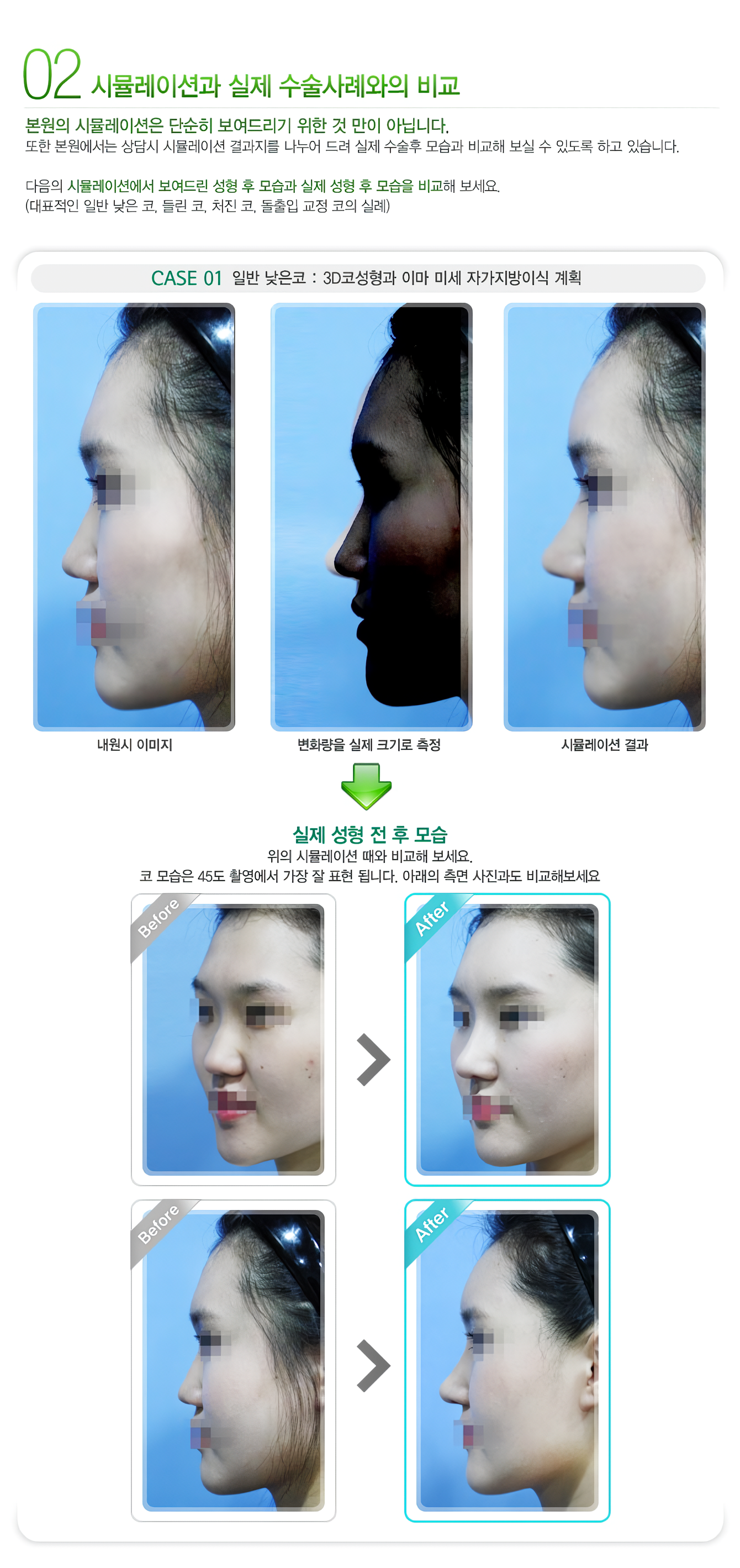 3D 코성형의 효과와 수술사진